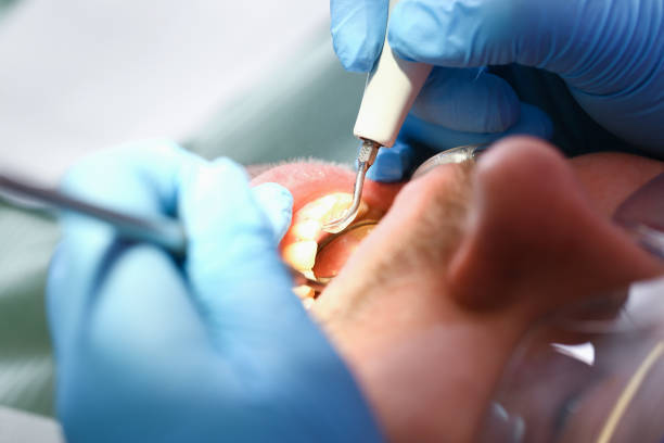 Best Chipped Tooth Repair Near Me  in Neffs, OH